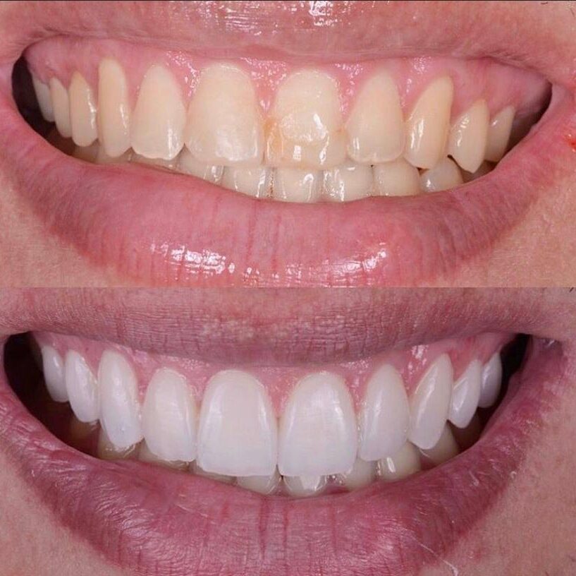 antes e depois de uma mulher sorrindo