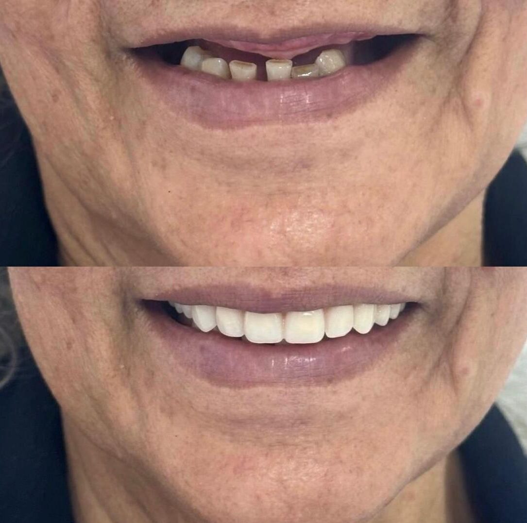 antes e depois de uma senhora com protese dentaria