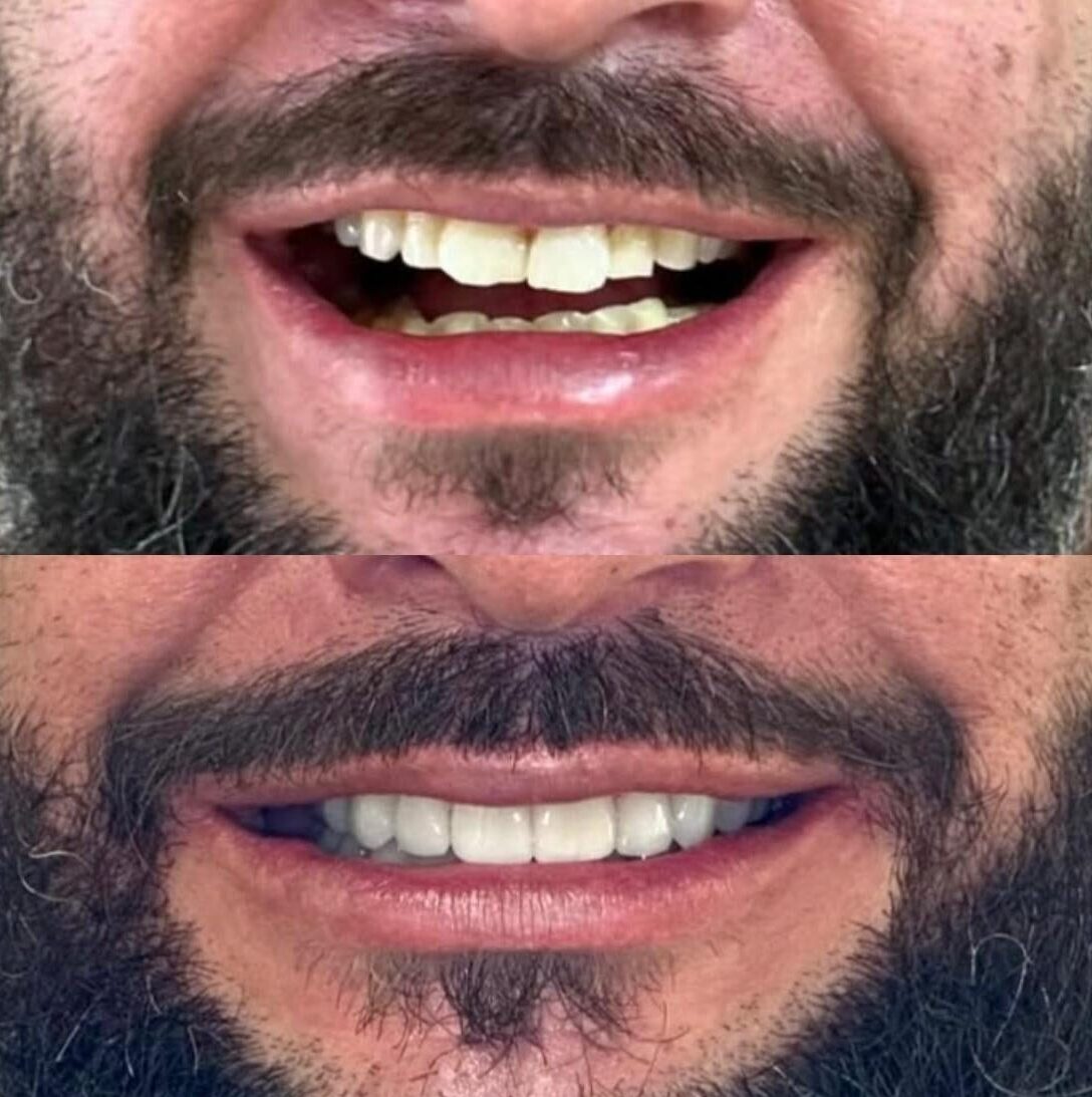antes e depois de um paciente sorrindo com lente de faceta dental de porcelana